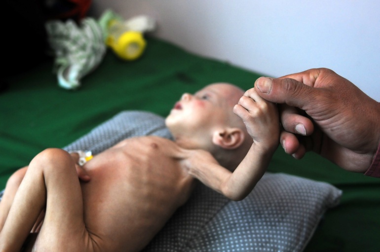 ضحايا حصار السعودية لليمن من المدنيين بالملايين (محمد حمود/ Getty)