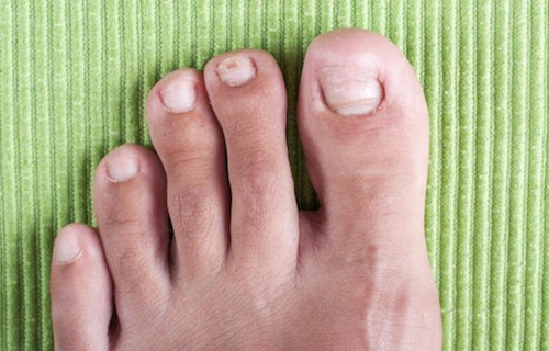 4 مشاكل مقز زة ي مكن أن ت صيب قدميك وطرق علاجها