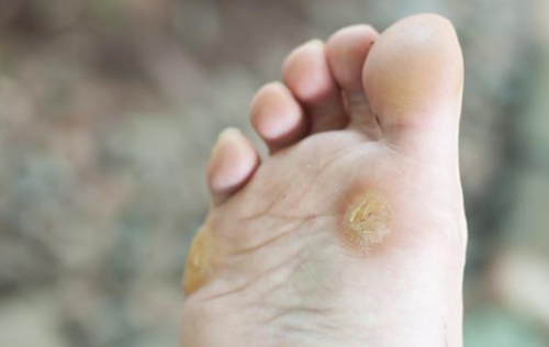 4 مشاكل مقز زة ي مكن أن ت صيب قدميك وطرق علاجها