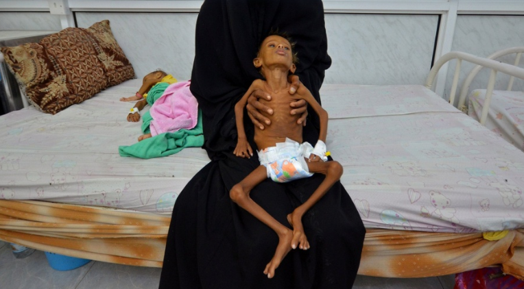 مجاعة اليمن حرب السعودية