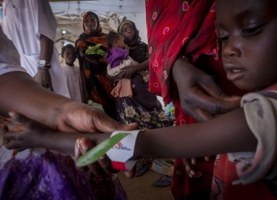 طفل سوداني يعاني من سوء التغذية