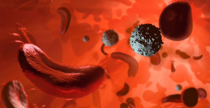 Sickle cell anaemia, illustration