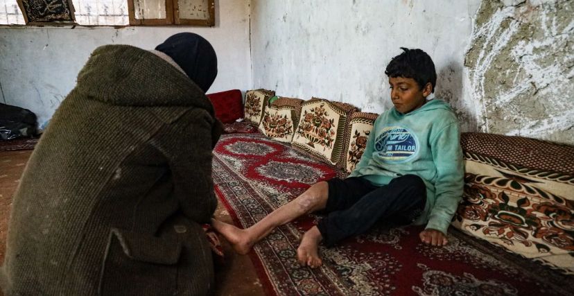 طفل سوري تضررت قدمه نتيجة انفجار قنبلة عنقودية