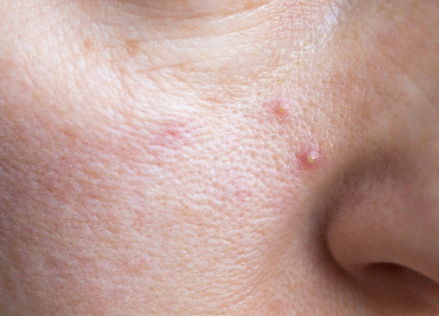 Oily Skin Acne Closeup With Pimples On Face (pustule)